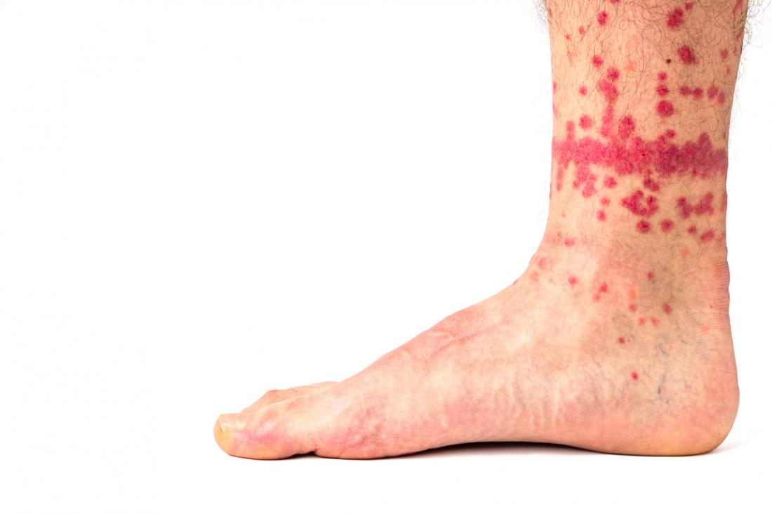 Can Humans Carry Fleas From One Home To Another